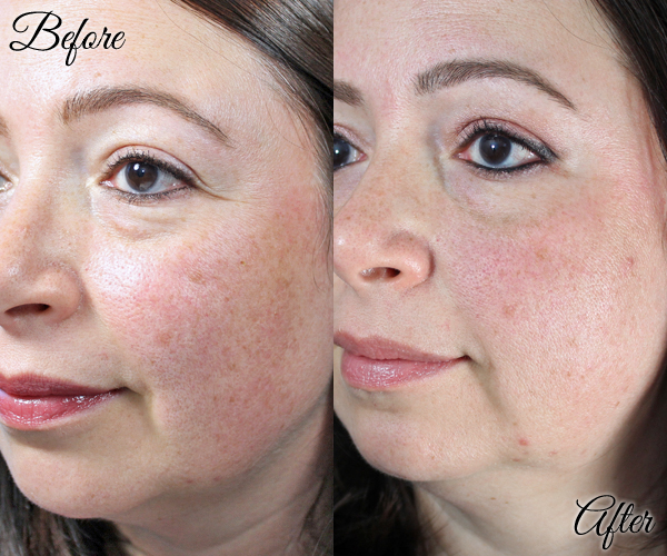 PIcoWay Laser and SkinMedica Vitalize Peel - Before & After