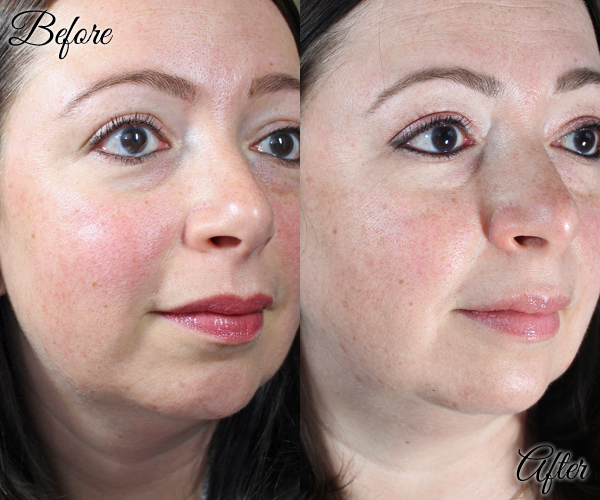 PIcoWay Laser and SkinMedica Vitalize Peel - Before & After