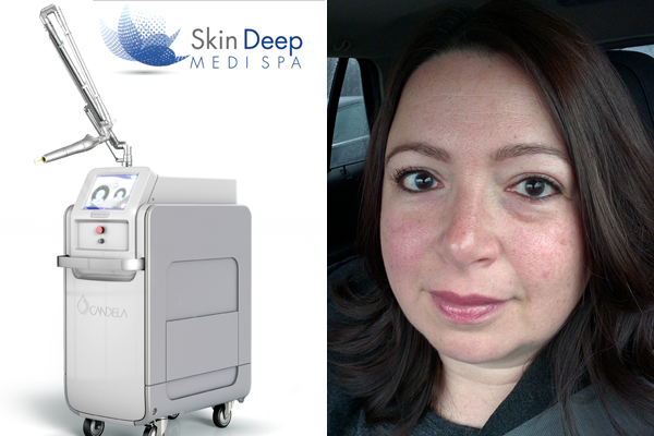 SkinDeep Medi Spa PicoWay Laser Treatment